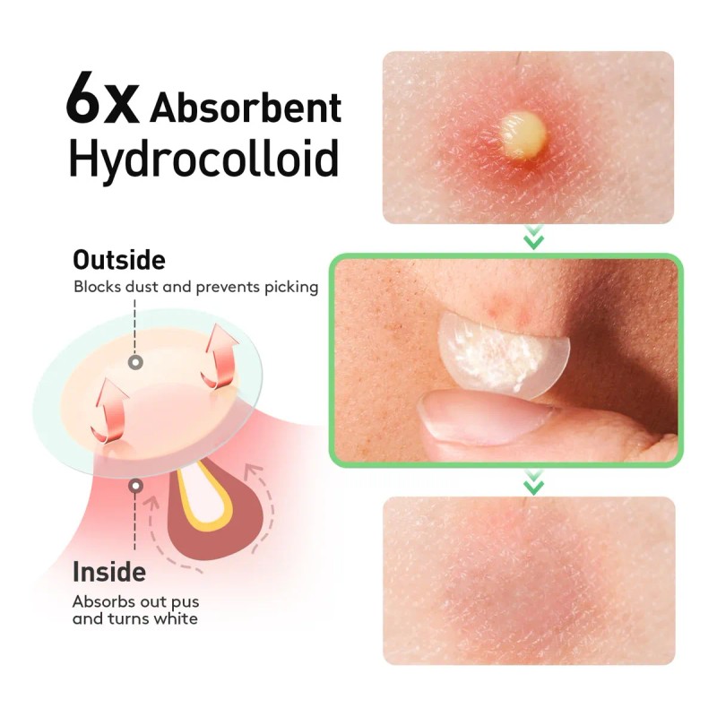 Parches Invisibles Acné