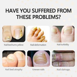 Nagelpilz Laser, Nagelpilz Behandlungs Gerät für Finger und Fußnägel, Nagelpilz Behandlung Schnell Intensiv, Wiederaufladbares Tragbares Nagelpilz Laser Therapie Gerät, 405nm+470nm+650nm+905nm