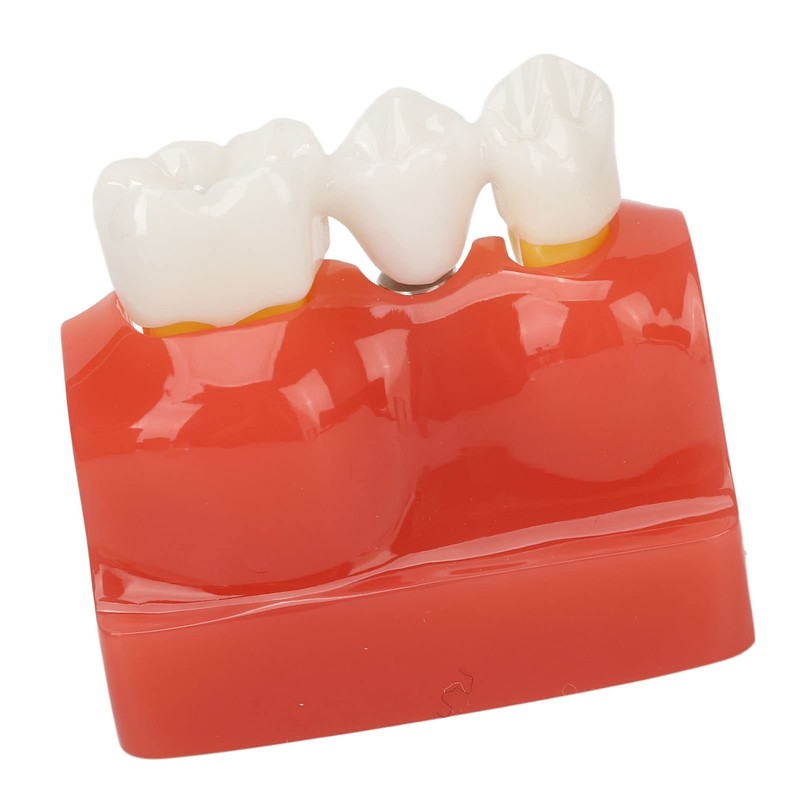 Dental Implant Teeth Model, Dental Implant Analysis Crown Bridge Model,