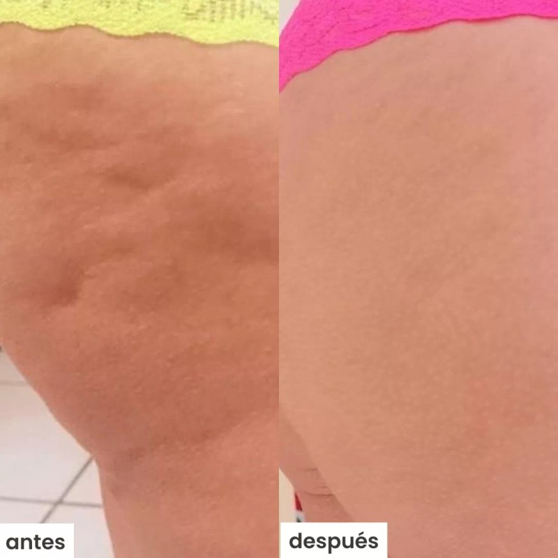 Azala Natura Kit Azala Natura Con Ventosa (celulitis)