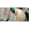 Acne Limpieza Facial Kit Quita Manchas Cara Barros Shelo Nab