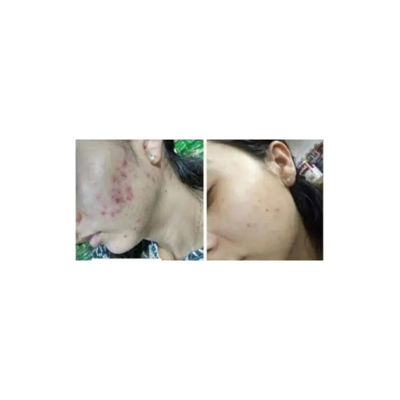 Acne Limpieza Facial Kit Quita Manchas Cara Barros Shelo Nab