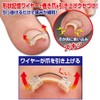 Cyplus Wire Guard, Nail Lifting, Memory Alloy Wire, Hook Nails