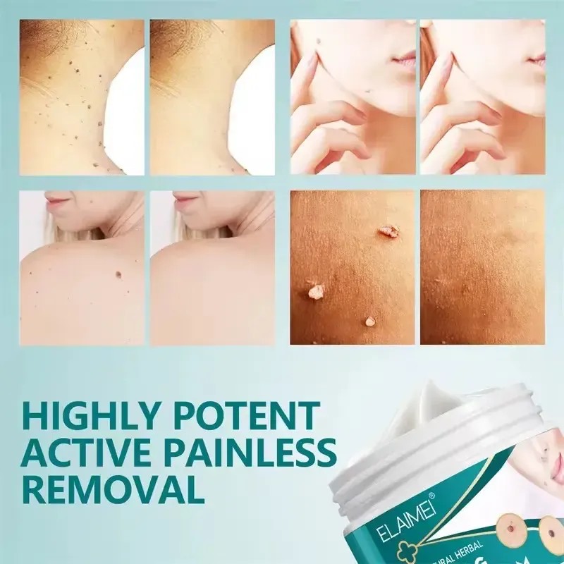 Crema Removedora Eficaz Mezquinos Verrugas Lunares Sin Dolor