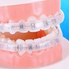 Comfort Covers for Braces - Protector bucal ortodóntico, protector de