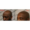 B - Scalp micropigmentation pigments by DermMicro (B)