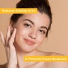 Toque Peróxido De Benzoilo 2,5% Acne Treatment Gel Crema -
