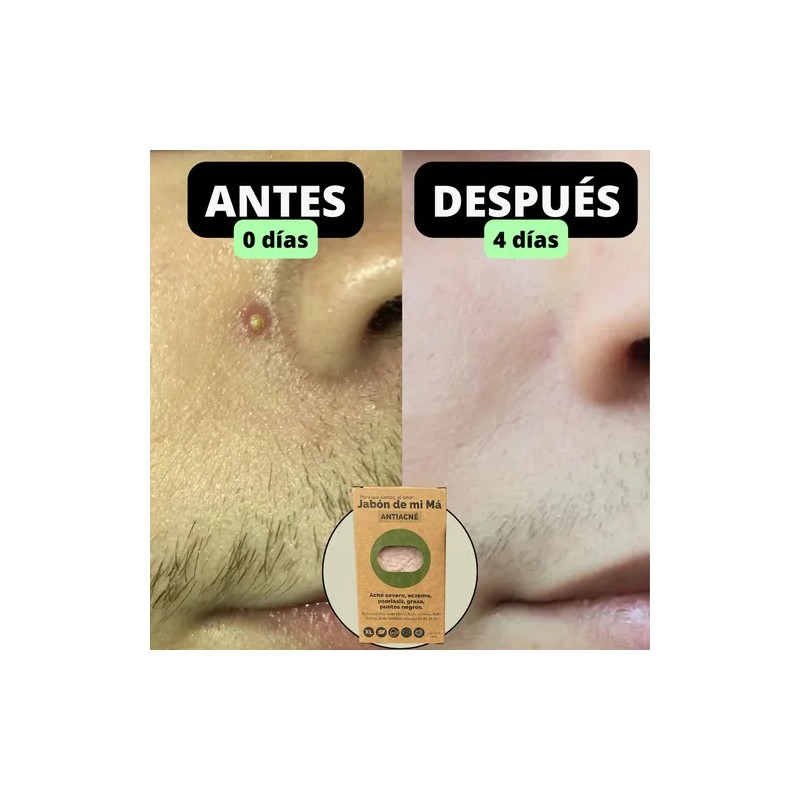 Jabon Antiacné De Mi Má | Ácido Salicílico