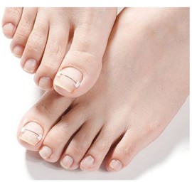 Diesel Corrector, single item, ingrown toenail correction care / 디젤 코렉터 단품 파고드는 발톱 교정 케어