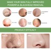 Blackhead Remover, Pack of 60 Blackhead Remover, Blackhead Remover, Clear