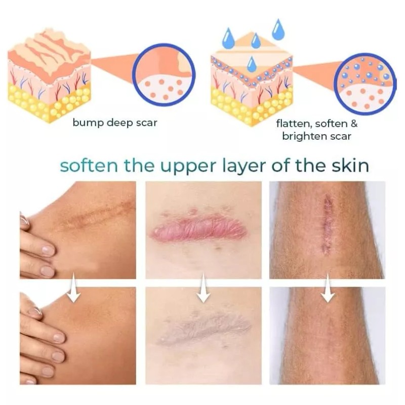 Jaysuing Crema Gel Reparador Cicatrices Acné Jaysuing 50ml Estrías
