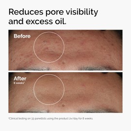  The Ordinary The Ordinary Niacinamide 10% + Zinc 1%, Smoothing Serum for Blemish-Prone Skin