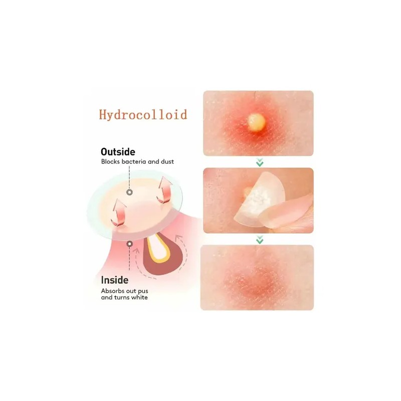 Parches Antiacné Acne Patche Hydrocolloid Para Rostro, Pack 600 Unidades