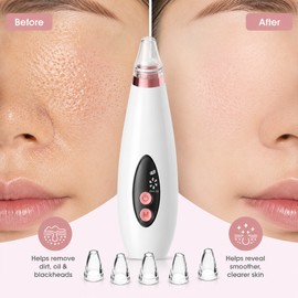 USB Rechargeable Blackhead Remover – Adjustable Suction Pore Vacuum Cleaner with Water-Cycle Facial Cleansing Design