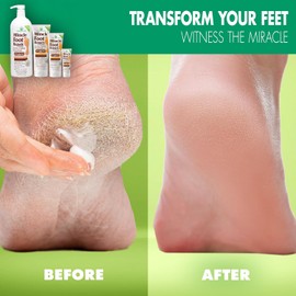 Miracle of Aloe Aloe Vera Lotion & Foot Cream Combo - All Over 1 oz + Foot Repair 4 oz Soothing for Dry Skin Hands Heels & Body 5 Ounce Safe for Cracked Feet / 알로에 베라 로션 & 풋 크림 콤보 - 올 오버 1온스 + 발 리페어 4온스 건조한 피부 손 발뒤꿈치 및 바디를 위한 진정 갈라진 발을 에 안전한 5 Ounce