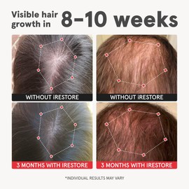 iRestore Advanced Hair Growth Supplement for Women, Hair Vitamins for Faster Hair Regrowth, Best for Hair Loss and Thinning - 1 Month Supply Each - 1 Count (Pack of 2) - Black