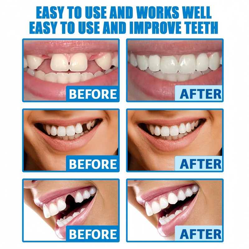 Temporary Tooth Filling Kit,Temporary Tooth Repair Kits,Moldable False Teeth Replacement,False