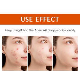 YAFUSIPE Acne Treatment for Face Hormonal Cystic Stubborn Acne Cream Back Butt Acne Spot Treatment for Teens Adults Moisturizer Pimple Rapid Clearing Cream for Breakouts Blemish Overnight 30g