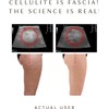 Ashley Black’s FasciaBlaster Trigger Point Fascia Tools for Recovery, Anti-Cellulite