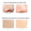 EMS Ultrasonic Skin Scrubber Blackhead Pimple Removal Lifting Ion Pore