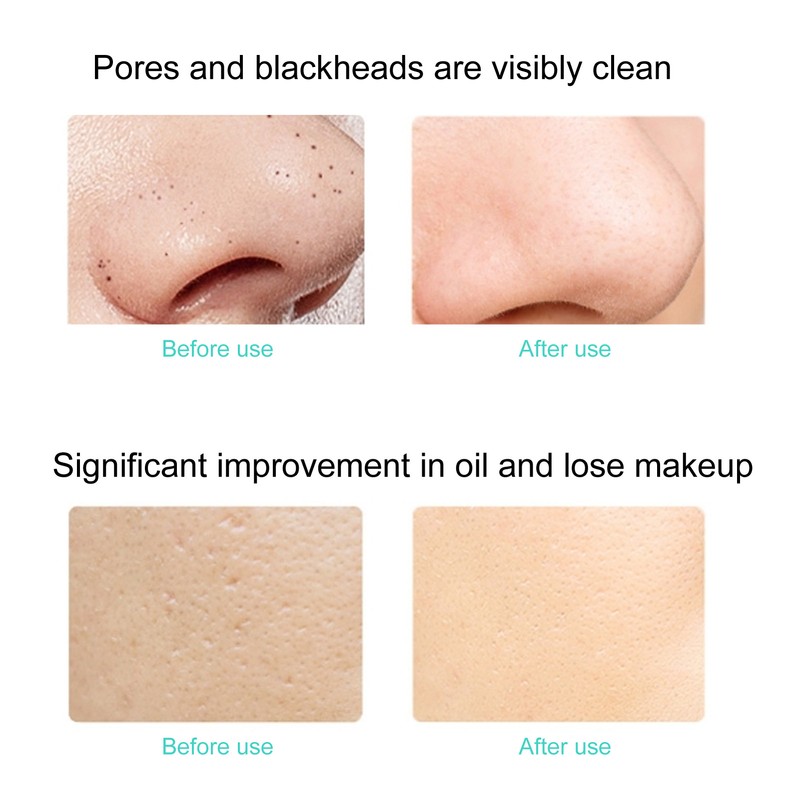 EMS Ultrasonic Skin Scrubber Blackhead Pimple Removal Lifting Ion Pore