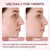 Effective Acne Treatment for Face - Acne Drying lotion -