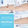 Zip Stitch Laceration Repair Without Stitches Butterfly Bandaids Quick Clot