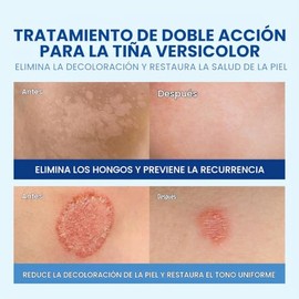 Gel de baño antifúngico con aceite de árbol de té, gel de baño para eccema, trata la tiña, el acné de espalda y la picazón de la tiña, jabón antifúngi
