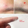 25 Parches Para Eliminar Cicatrices, Acné, Acné, Acné, Ma