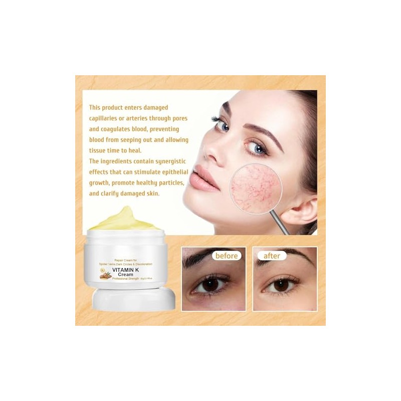 Crema para Venas Varicosas y Araas Vasculares, con Vitamina K,