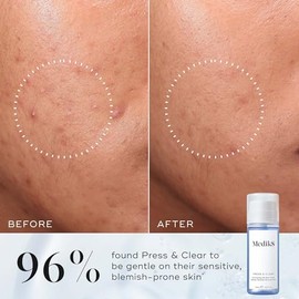 Medik8 Press & Clear, Exfoliating 2% BHA Clarifying Toner - 150ml | Exfoliating 2% BHA Clarifying Toner, Salicylic & Tranexamic Acid, Reduces Blemishes, Blackheads & Oiliness