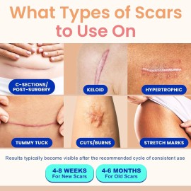Adamson Cinta De Silicona Para Cicatrices Arrugas Queloide Color Piel 1.6 X 60 Pulgadas