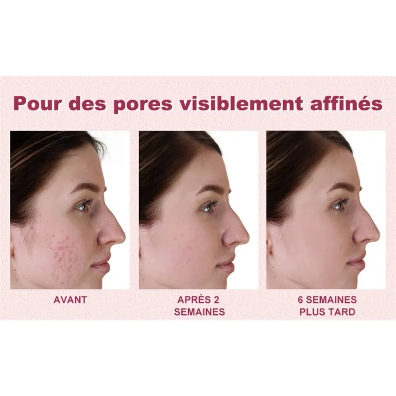 Sérum De Ácido Azelaico 20 G, Reduce Las Imperfecciones