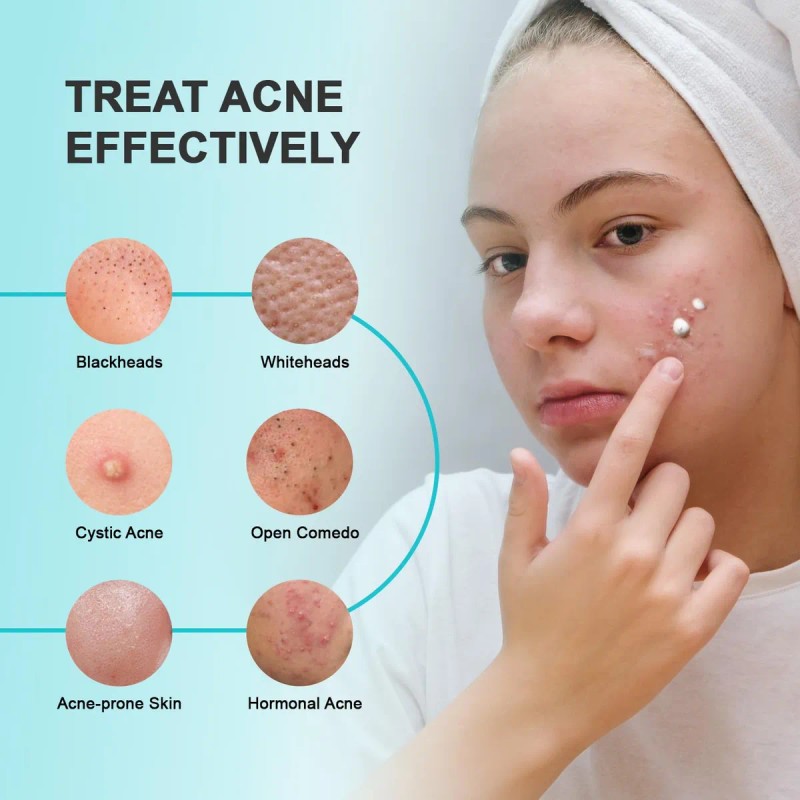Crema Para El Tratamiento De Manchas De Espinillas Para Acné