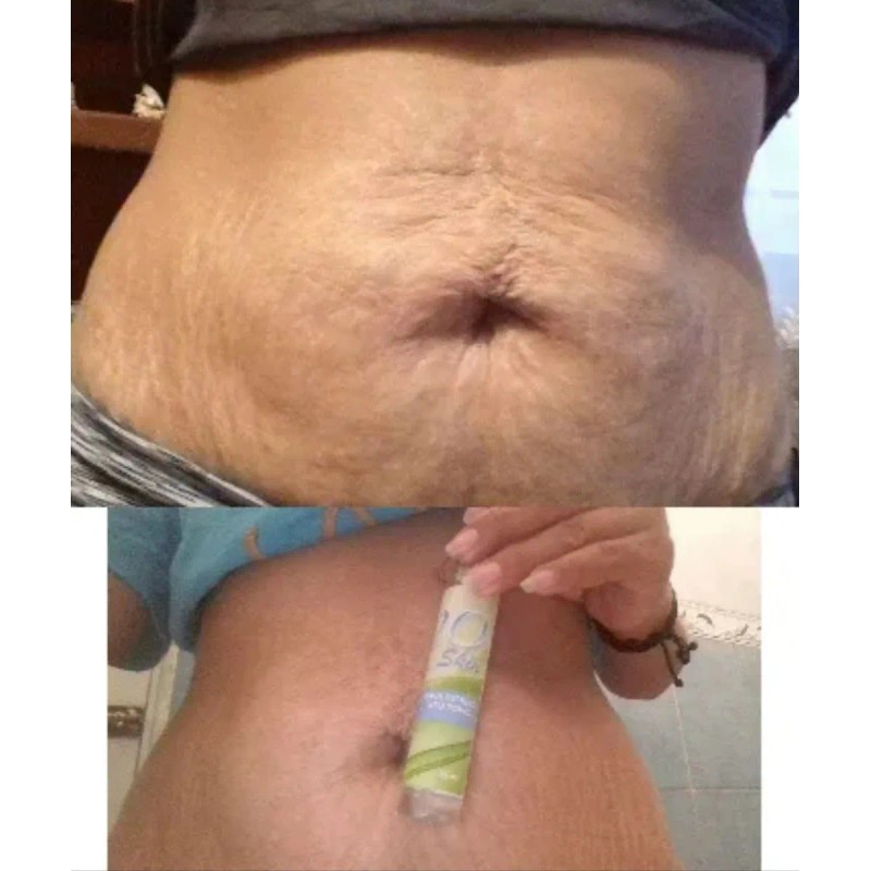 20skin Gel Para Estrías 50ml Para Todo Tipo De Estrias