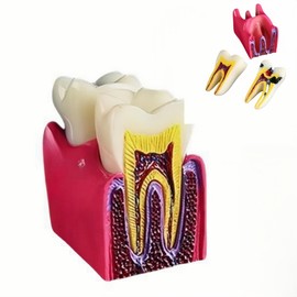 6 Times Dental Caries Model Teaching Typodont Tool for Dentists, Patients, Teachers and Students Studying and Researching (Teeth Removal)