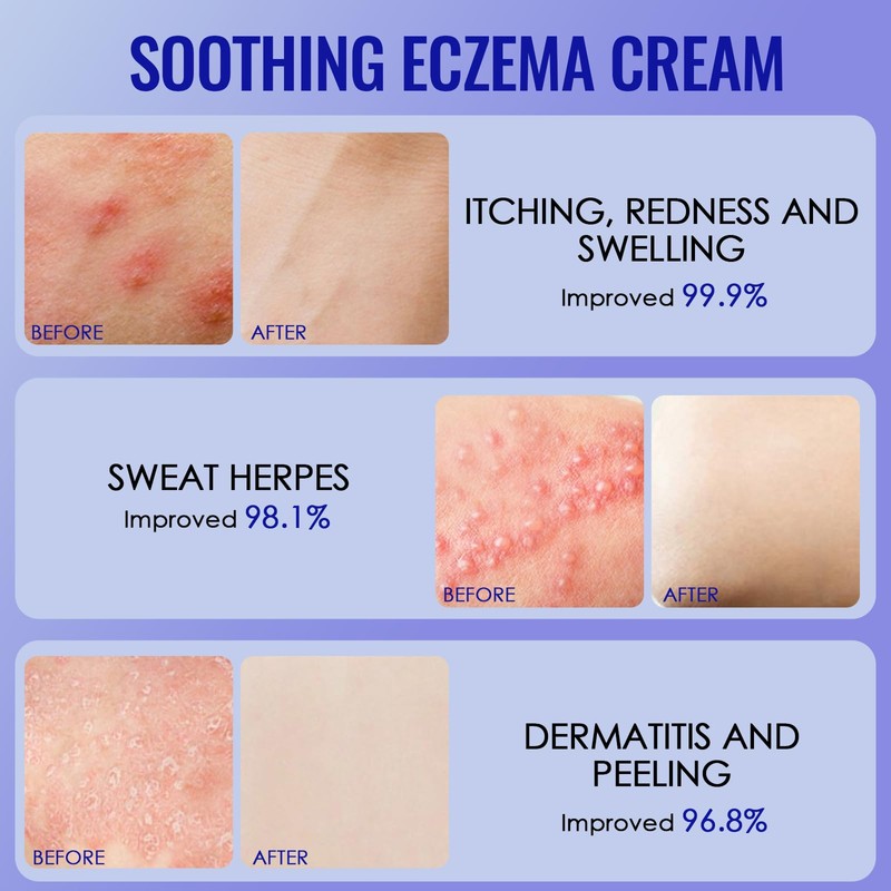 100g Eczema Cream, Skin Soothing Cream, Gentle Barrier Cream