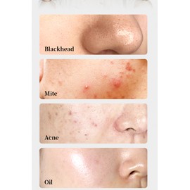 eXempt Visual Blackhead Remover, Face&Skin Cleaner Pore Acne Vacuum WiFi APP connection