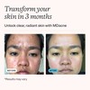 MDacne - Acne Treatment- Benzoyl Peroxide Cream 2.5% - Unclogs