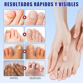 Parches Corrector Uñas Pies 21 Unidades Ingredientes Naturales | Mejora la coloración y recupera el aspecto sano de las uñas, cuidado diario para uñas