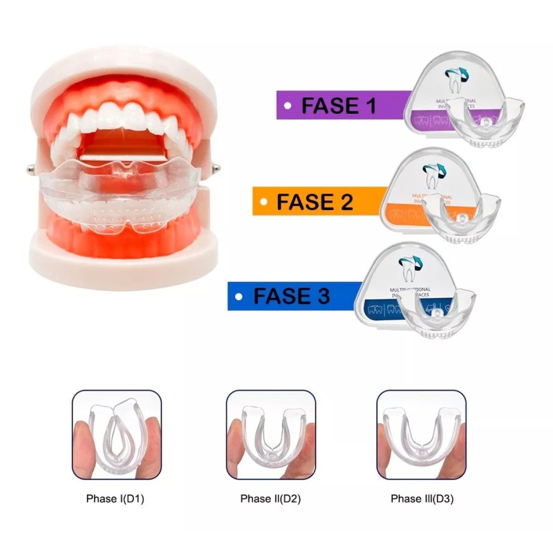 Universo en Linea Retenedor De Dientes Para Corrección De Sonrisa