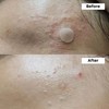 NINELESS [NINELESS]★1+1★ A-Control 10% Azelaic Acid Serum 30ml