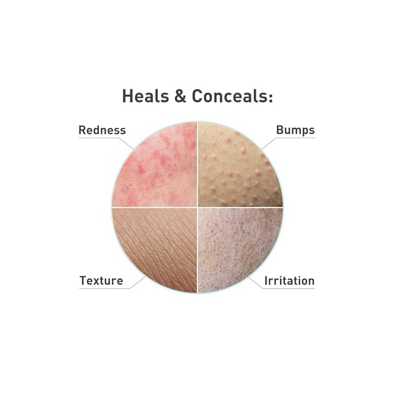 ProCure Rosacare Gel Para Reducción de Enrojecimiento