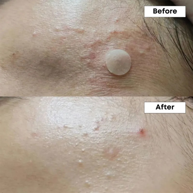 Nineless Sérum Facial Ácido Azelaico 10% Controla Imperfecciones y Brillo