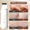 Limpiador Facial Peeling Ultrasónico Portatil Skin Scrubber