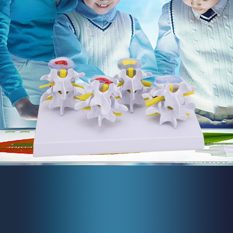 4-stage Medicals Human Lumbar Vertebrae Combination of Normal and Pathological