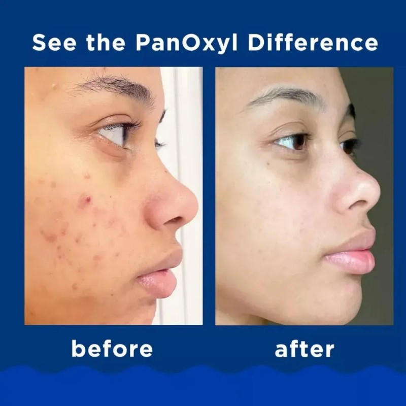 Jabón Espumoso Panoxyl Acne, Peróxido De Benzoilo, Maxi