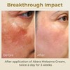 ABERA Melasma Cream (Premium Version) - Cream for Face Treatment,