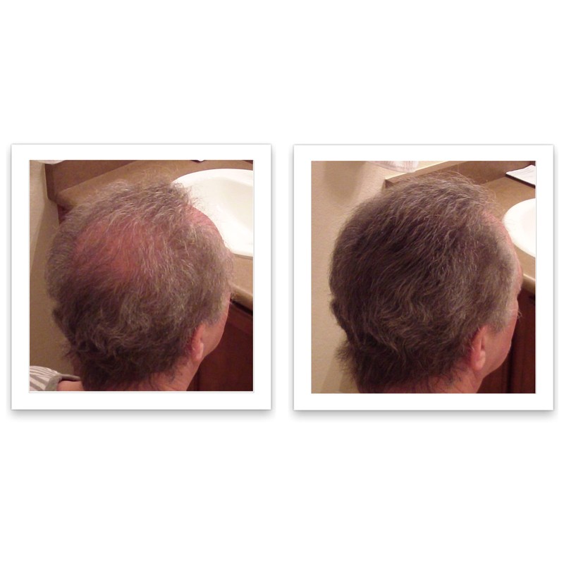 Caboki Value Pack 4, 360-Day Supply (Light Brown)