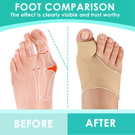 Hallux Valgus Socks, Hallux Valgus Bandage, Hallux Valgus Correction, Bunion Corrector with Fixed Strap, Hallux Valgus Splint, Hallux Valgus Correction for Men and Women (Skin Colour, L)